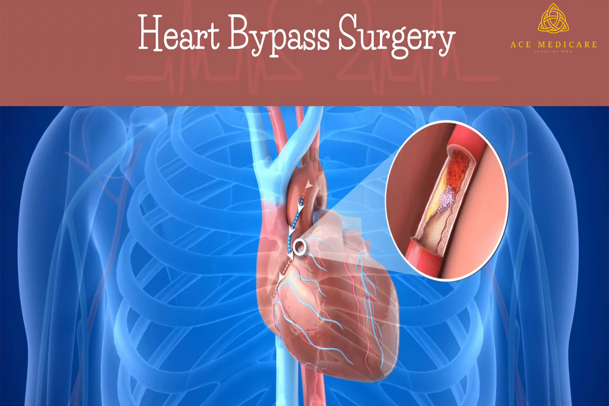 Debunking Common Myths About Coronary Bypass Surgery